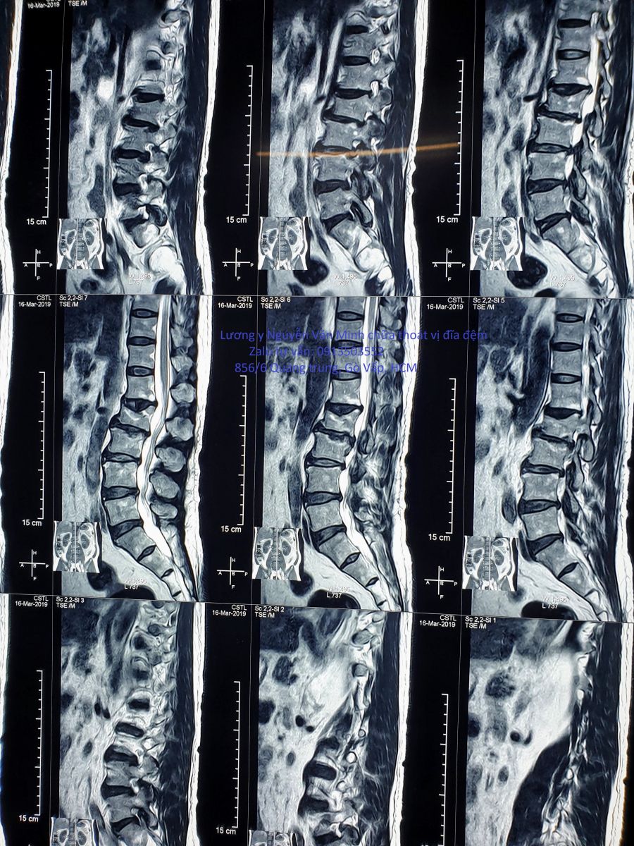 Hình ảnh thoát vị đĩa đệm